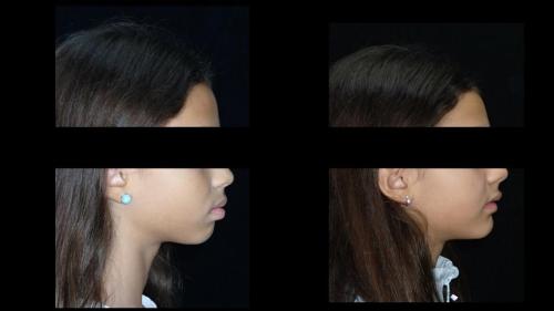large-Cambio labial