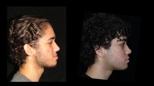 large-Combinacion con cirugia