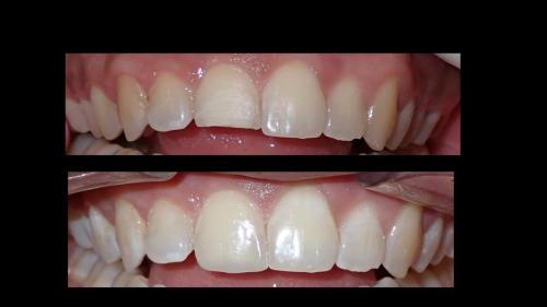 large-Fractura con resina