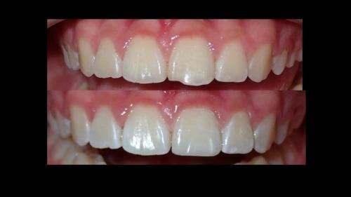 large-Fractura