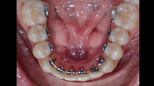 large-Ortodoncia Lingual