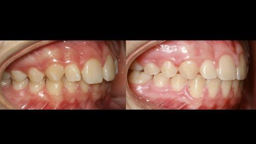large-Resultado de avance de la mandibula