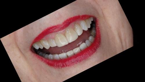 large-Sonrisa Adulto
