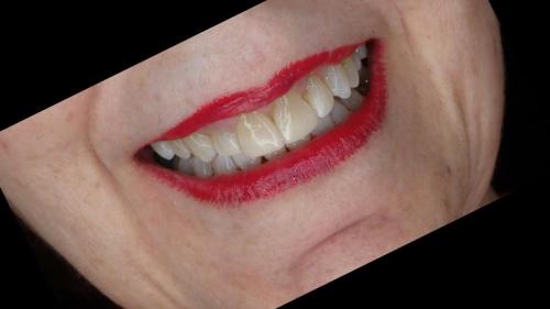 large-Sonrisa en adulto